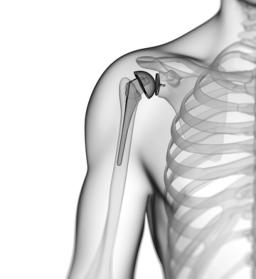A transparent close-up of a shoulder showing the bones of the shoulder, upper arm and ribs, with an artificial joint
