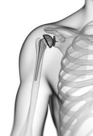 A transparent close-up of a shoulder showing the bones of the shoulder, upper arm and ribs, with an artificial joint